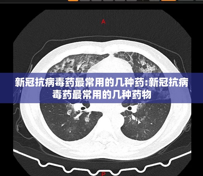 新冠抗病毒药最常用的几种药:新冠抗病毒药最常用的几种药物